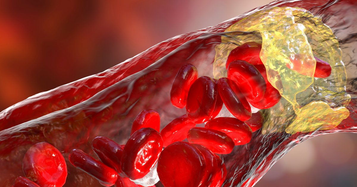 Cardiovascular disease: key molecular pathway affecting atherosclerosis ...